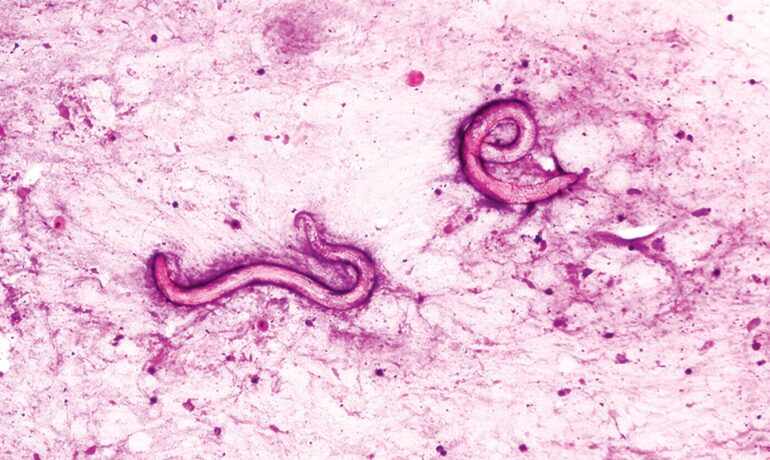 Man’s body crawling with parasitic worms after infected kidney transplant at US hospital