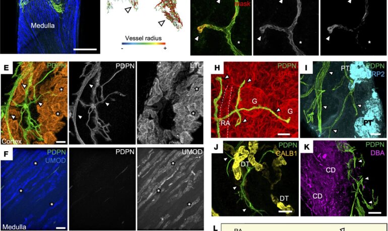 Kidney transplant rejection associated with changes in lymphatic vessels, new research shows
